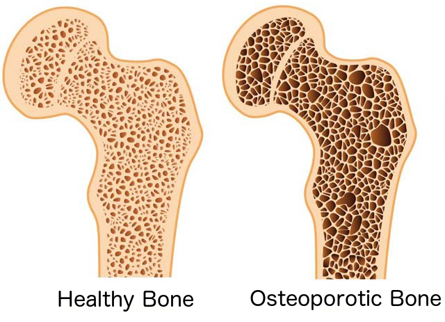 osteoporosis